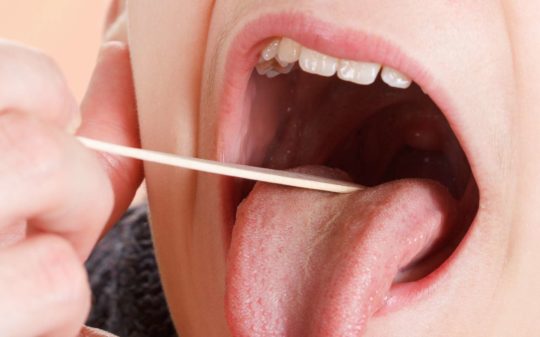 سرطان الحنك الرخو