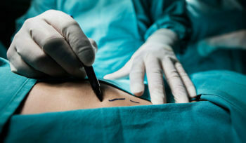 عملية استئصال الرحم