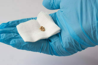 حصوات المرارة وحصى الكلي