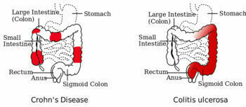 صورة توضيحية لالتهاب القولون التقرحي وداء كرون