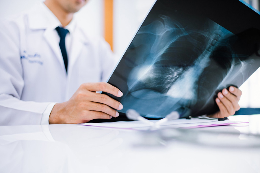 حالات من الواقع عظم دجاج يعلق لمدة 5 أيام برئة رجل منصة شفاء عظم دجاج مستقر في الرئة