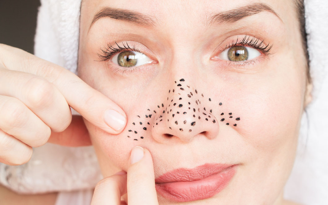 إزالة الرؤوس السوداء.. 3 حيل منزلية لبشرة زجاجية