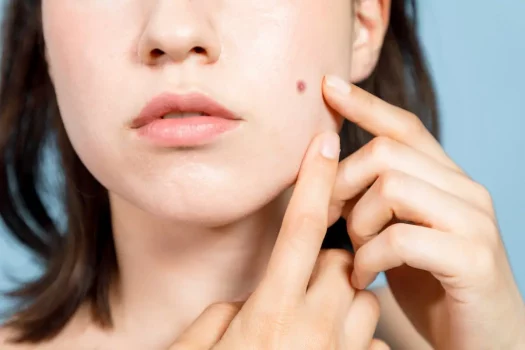 التخلص من حب الشباب