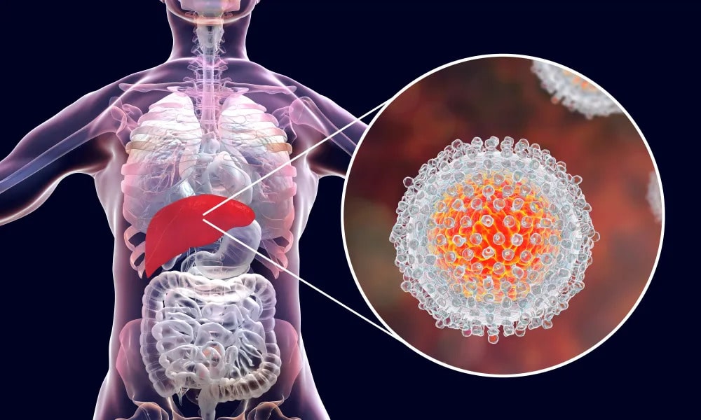 Is There A Hepatitis E