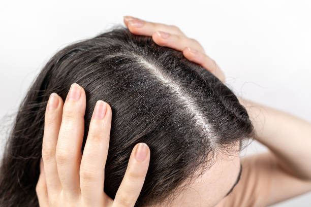 كم يستغرق علاج قشرة الشعر؟