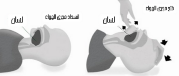 منع ابتلاع اللسان أثناء النوم