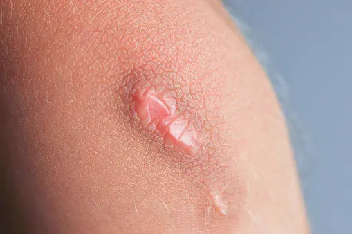 قرحة الفراش