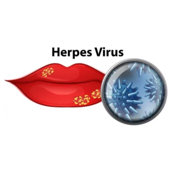 الهربس الفموي