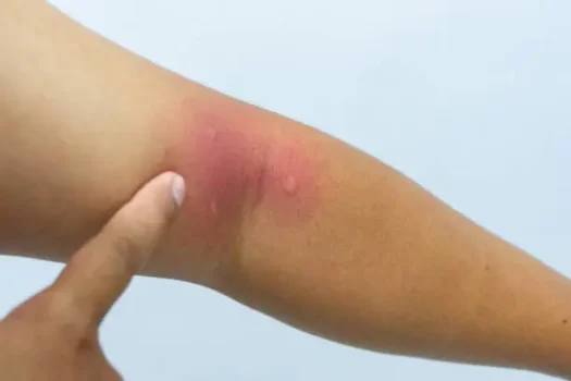 لدغات الحشرات