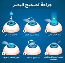 جراحة تصحيح البصر