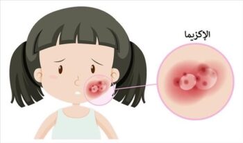 صورة توضيحية للاكزيما 
