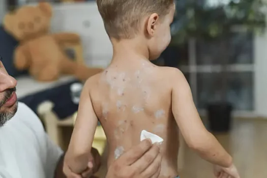 علاج الأكزيما عند الأطفال