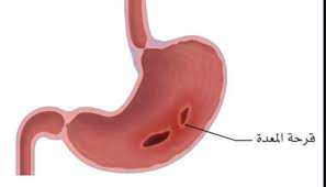 قرحة المعدة