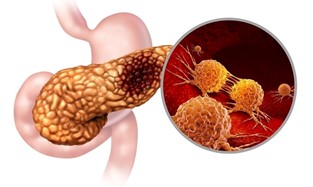 صورة توضيحية للالتهاب البنكرياس