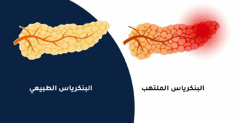 أعراض التهاب البنكرياس المزمن
