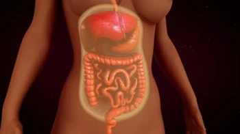 أعراض التهاب الصفاق عند النساء